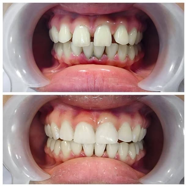 Full Mouth Reconstruction in Niles, MI